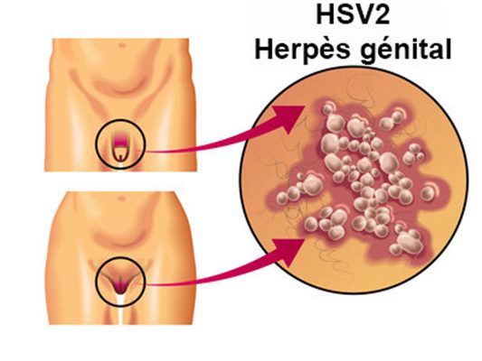 Herpès : symptômes, traitement, définition - docteurclic.com