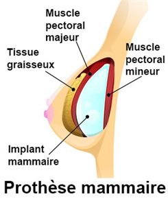 prothèse mammaire