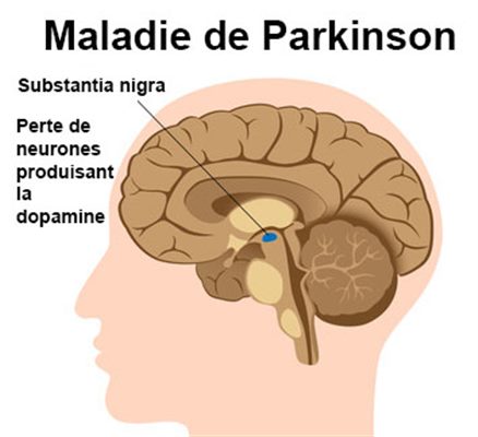 Maladie de Parkinson