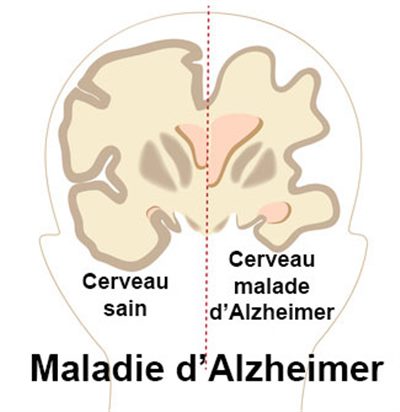 Maladie d'Alzheimer