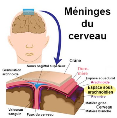 Hémorragie méningée