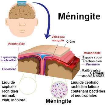 Méningite : des réponses à vos questions : faq santé Méningite : des réponses à vos questions : faq santé