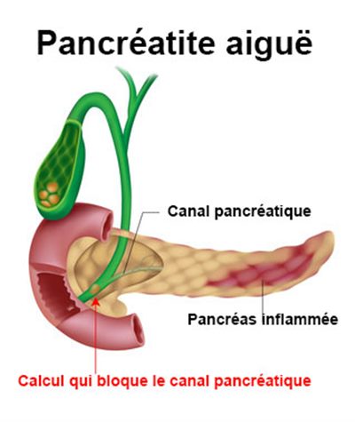 Pancréatite