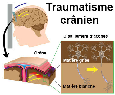 Que Faire En Cas De Traumatisme Cranien Chute Sur Le Crane Docteurclic Com