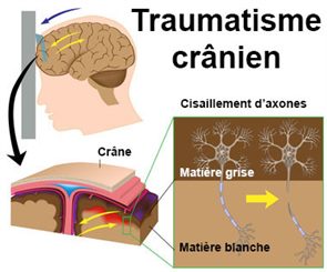 traumatisme crânien