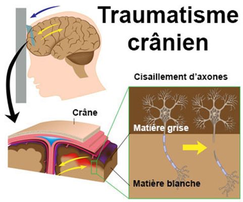 Que faire en cas  de traumatisme crânien (chute sur le crâne) sans perte de connaissance ?
