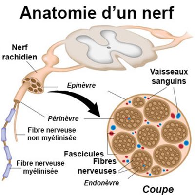 Multinévrite