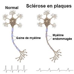 sclérose en plaques
