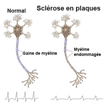 Sclérose en plaques : des réponses à vos questions