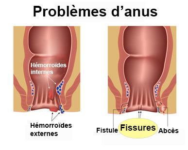 Fissure anale : définition - docteurclic.com