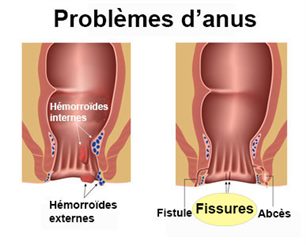 Fistule anale : symptômes, traitement, définition - docteurclic.com