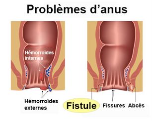 fistule anale