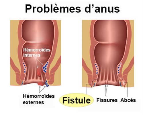 Fistule anale