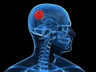 abcès du cerveau