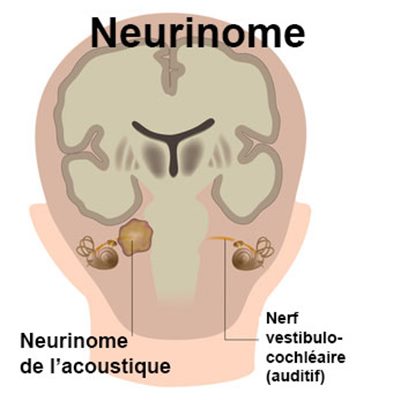 Neurinome