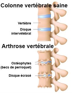 arthrose vertébrale