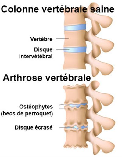 Arthrose vertébrale