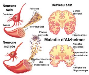 maladie d'alzheimer