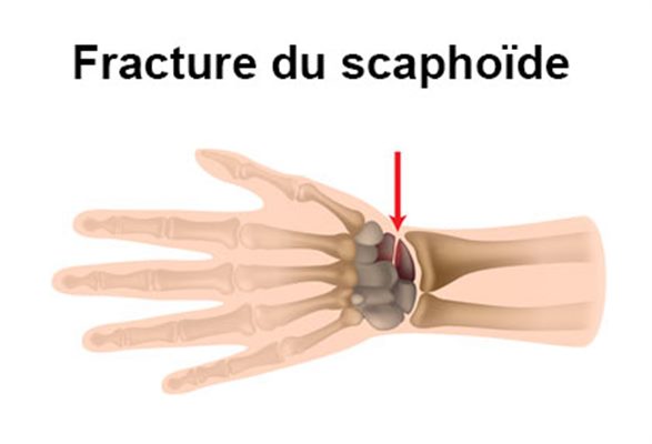 Fracture du scaphoïde : symptômes, traitement, définition 