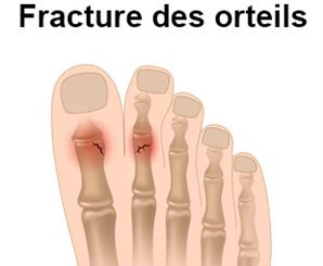 fracture de l'orteil
