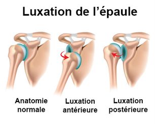 luxation de l'épaule