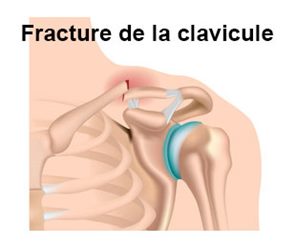 fracture de la clavicule