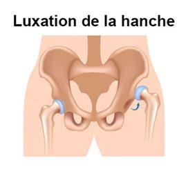 luxation de la hanche