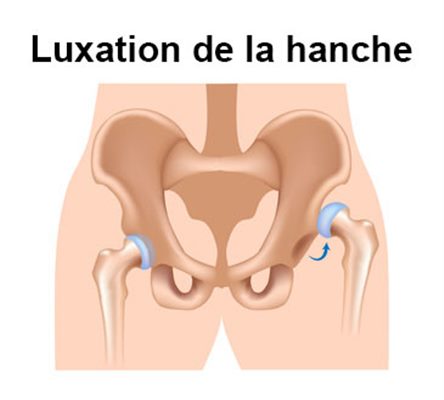 Luxation congénitale de la hanche
