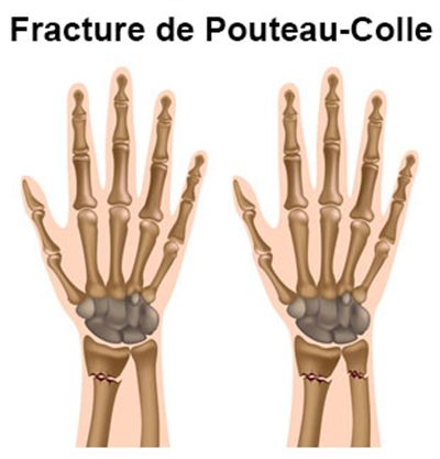 Fracture du poignet : symptômes, traitement, définition ...