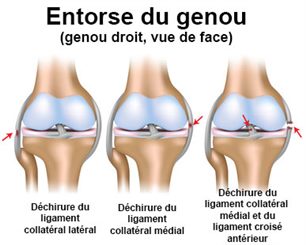 Ligaments du genou distendus - docteurclic.com