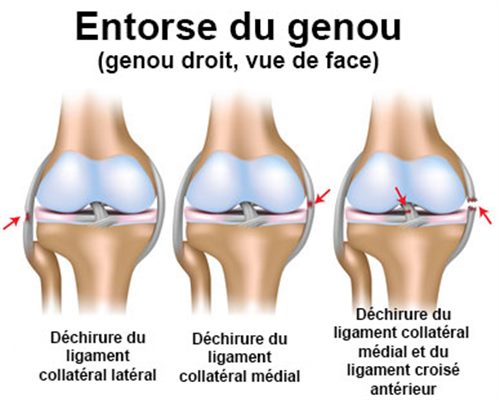 Que faire en cas d'entorse du genou ?