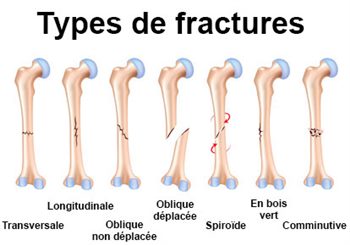 types de fractures