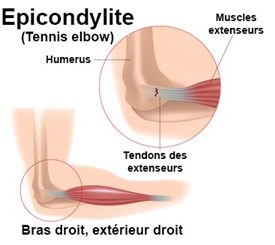 épicondylite