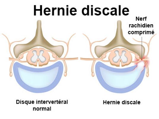 Hernie discale