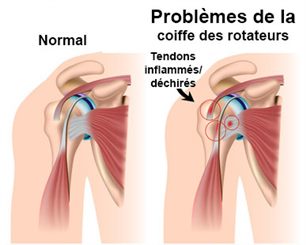 Douleur de l'épaule : symptômes, traitement, définition ...