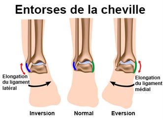 Ligaments du genou distendus - docteurclic.com