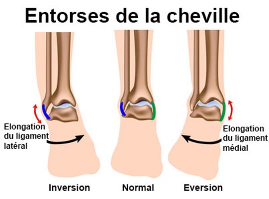 Entorse de la cheville