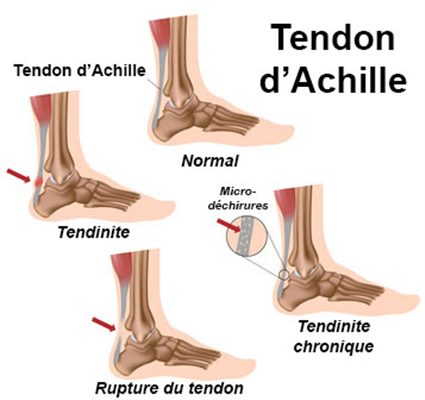 Tendinite du tendon d'Achille