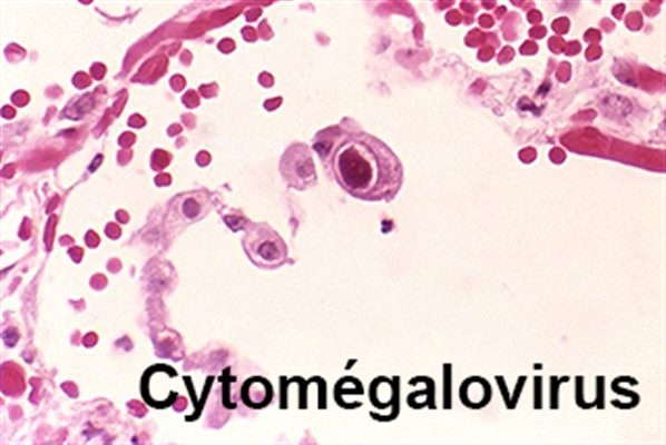 Cytomégalovirus