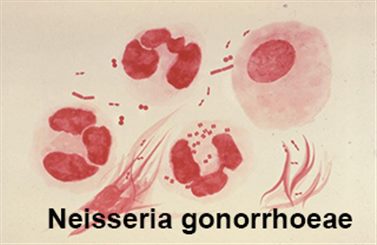 neisseria gonorrhoeae