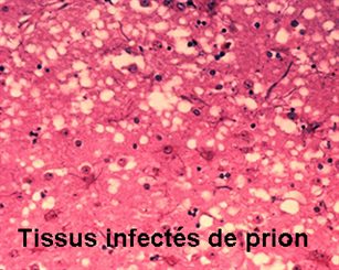 ESB:encéphalopathie spongiforme bovine