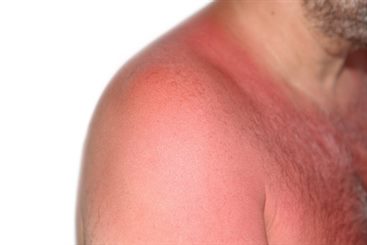 coup de soleil