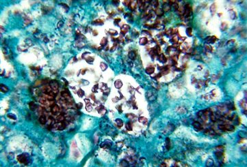 histoplasmosis capsulatum