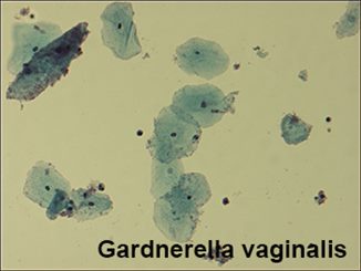 gardnerella vaginalis