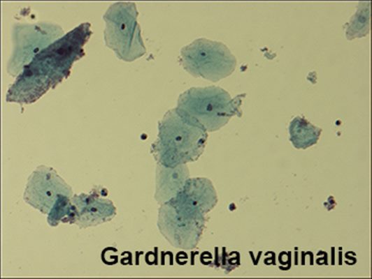 Infections à Gardnerella vaginalis