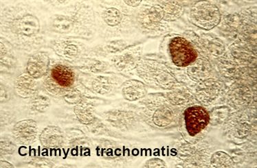 chlamydia trachomatis