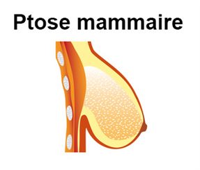 ptose mammaire