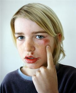 contusion
