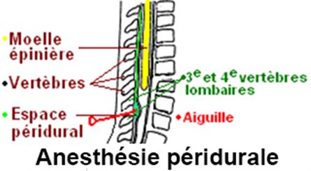 anesthésie péridurale