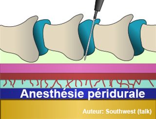 anesthésie péridurale